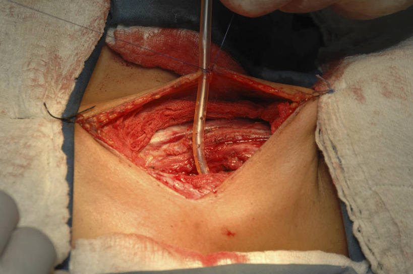 脖子,手,横图,俯视,室内,特写,白天,管子,拿着,血液,摄影,部分,手术,手术室,甲状腺,彩图,高角度拍摄