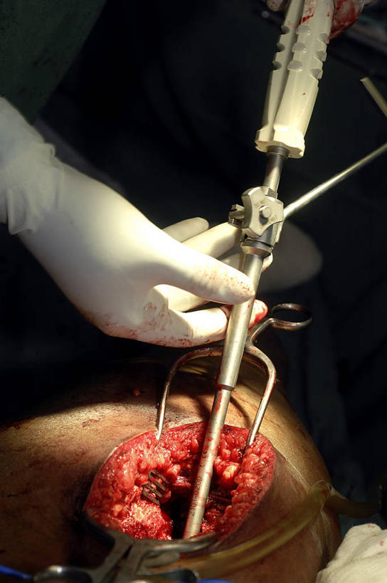 手,关节,竖图,室内,安全,苏丹,防护,手套,血液,摄影,臀,保护,部分,手术,手术室,准确,保险,假肢,整形,保全,周全,安稳,安定,防护手套,股骨,骨质疏松症,平安,彩图,外科手术,医疗美容外科手术,整形手术,骨关节炎,人工髋关节