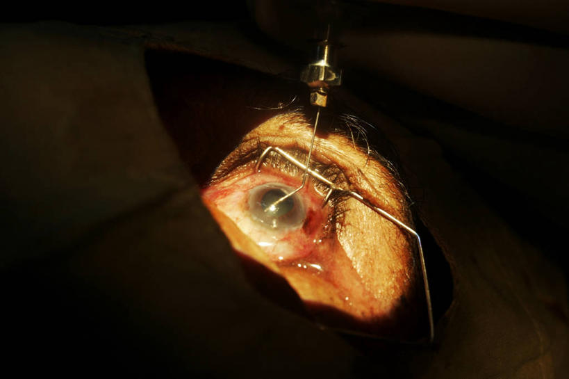 成年人,眼睛,虹膜,两个人,横图,室内,特写,苏丹,瞳孔,光,注射,眼部,摄影,部分,透镜,验光师,手术,眼球,手术室,准确,照明设备,医疗工具,眼,彩图,白内障