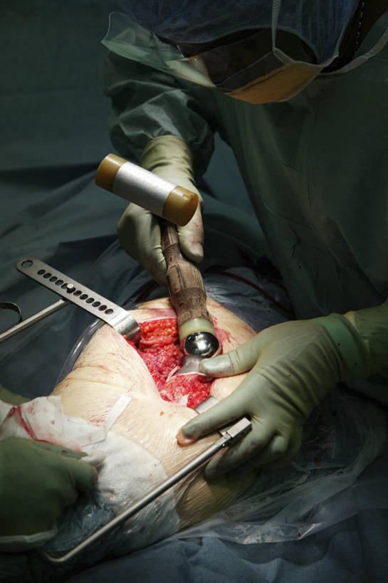 关节,两个人,病人,竖图,室内,分离,过滤,分开,英格兰,口罩,隔断,血液,遮掩,摄影,隔离,部分,手术,卫生,手术室,掩盖,遮挡,放入,净化,间隔,防护镜,预防,假肢,遮盖,防尘,外科医生,掩饰,断绝,隔开,屏蔽,屏绝,远离,中断,阻遏,阻隔,股骨,槌棒,手术器械,半身,彩图,手术衣