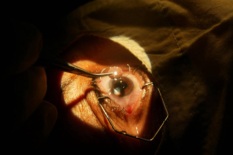 成年人,眼睛,虹膜,一个人,病人,横图,特写,瞳孔,眼部,摄影,部分,照亮,透镜,验光师,手术,视力,眼球,准确,痛苦,医疗工具,角膜,手术器械,眼,彩图