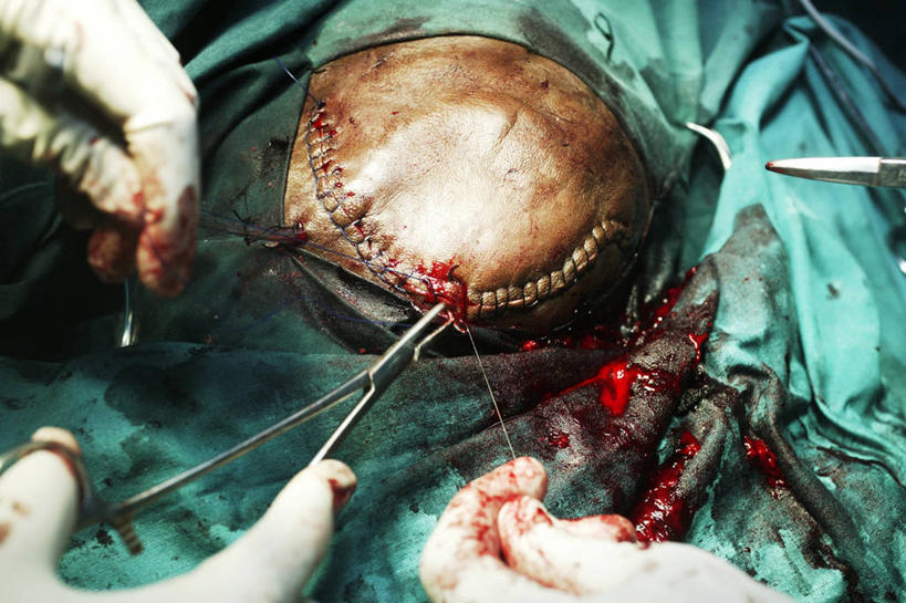 头,手,一个人,医院,横图,室内,特写,白天,安全,苏丹,镊子,防护,拿着,手套,血液,摄影,皮肤,保护,部分,手术,伤口,准确,拼接,解剖刀,保险,外科医生,保全,周全,安稳,安定,缝合,防护手套,技能,平安,头部,彩图,缝线