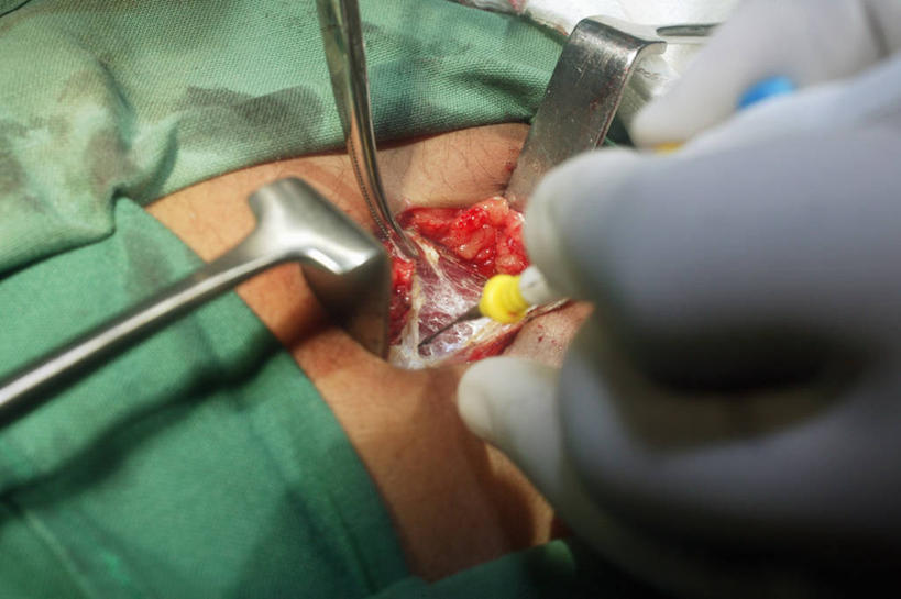 阑尾,两个人,横图,俯视,室内,特写,苏丹,纱布,血液,摄影,部分,手术,肠道,消化道,吸收,消化管,消化,排泄,手术器械,阑尾炎,摄取,彩图,高角度拍摄,消化腺,转运,消化系统