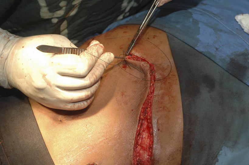 横图,俯视,室内,特写,安全,不锈钢,镊子,防护,手套,摄影,保护,部分,手术,手术室,拼接,保险,医疗工具,外科医生,保全,周全,安稳,安定,缝合,防护手套,平安,脾脏,彩图,高角度拍摄