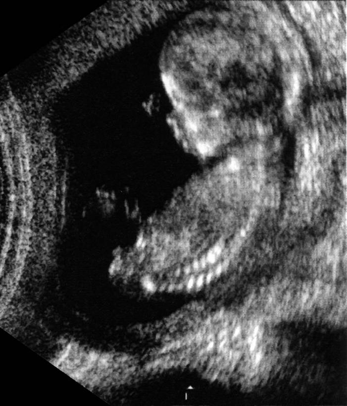 婴儿,儿童,子宫,一个人,无人,竖图,黑白,照片,室内,白天,侧面,纯洁,仅一个人,检查,朦胧,模糊,医学,小孩,可爱,摄影,活泼,检测,宝宝,B超,红外线,纯真,烂漫,无邪,胞宫,雌性生殖器官,第六脏器,女子胞,伶俐,天真,孩子,相片,半身,拍摄,照相,生殖器官