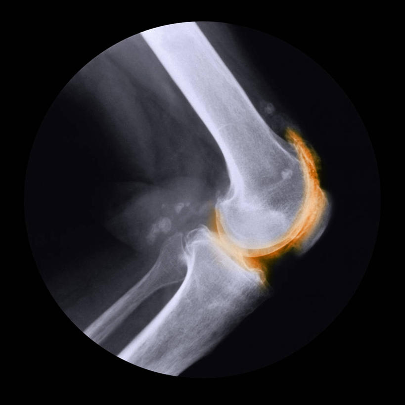 骨骼,无人,方图,x光片,室内,特写,白天,正面,黑色背景,辐射,科学,医学,骨头,骨架,医疗,疾病,科学技术,x射线,x光,髌骨,腓骨,股骨,胫骨,炎症,关节炎,彩图,发炎,电磁波,电磁辐射