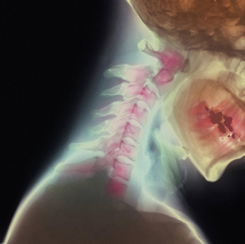 脖子,骨骼,无人,横图,x光片,室内,特写,白天,正面,黑色背景,辐射,科学,医学,骨头,骨架,医疗,疾病,科学技术,x射线,x光,损伤,脖,颈,颈部,彩图,电磁波,电磁辐射,挥鞭样损伤