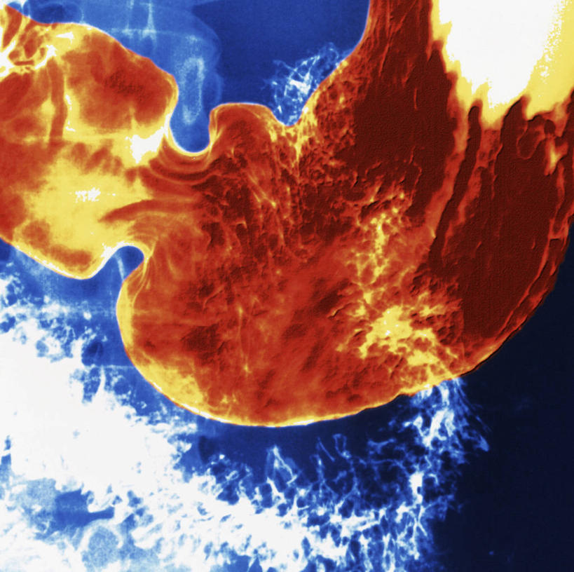 腹部,内脏,胃,动脉,静脉,无人,横图,x光片,室内,白天,正面,辐射,科学,医学,一个,人体,单个,医疗,生物学,人体器官,科学技术,x射线,器官,x光,自然科学,博物学,生物科学,胃部,彩图,电磁波,电磁辐射