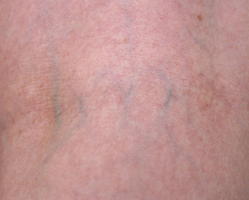 西方人,血管,一个人,横图,室内,特写,白天,正面,欧洲,欧洲人,仅一个女性,仅一个人,仅一个老年女性,皮肤,心血管系统,封闭,血液循环,老年女性,女人,女性,白种人,半身,彩图,管道系统